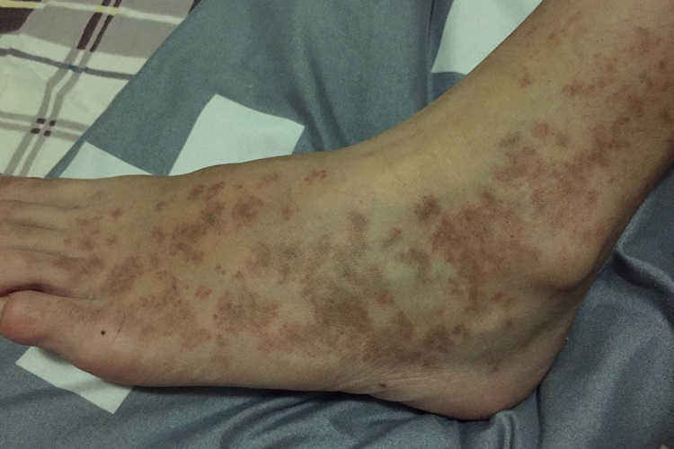 结节性多动脉炎脚部斑图