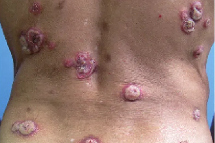 女性扁平湿疣症状图