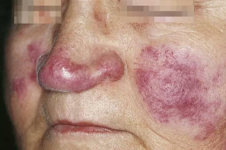 慢性皮肤型红斑狼疮图 慢性皮肤型红斑狼疮图