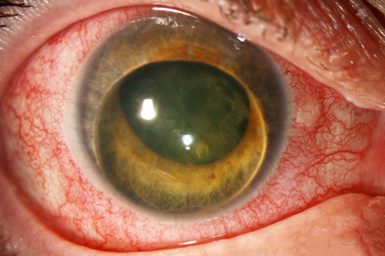 患者出现晶状体半脱位时,瞳孔区可见部分晶状体,散大瞳孔后可见部分