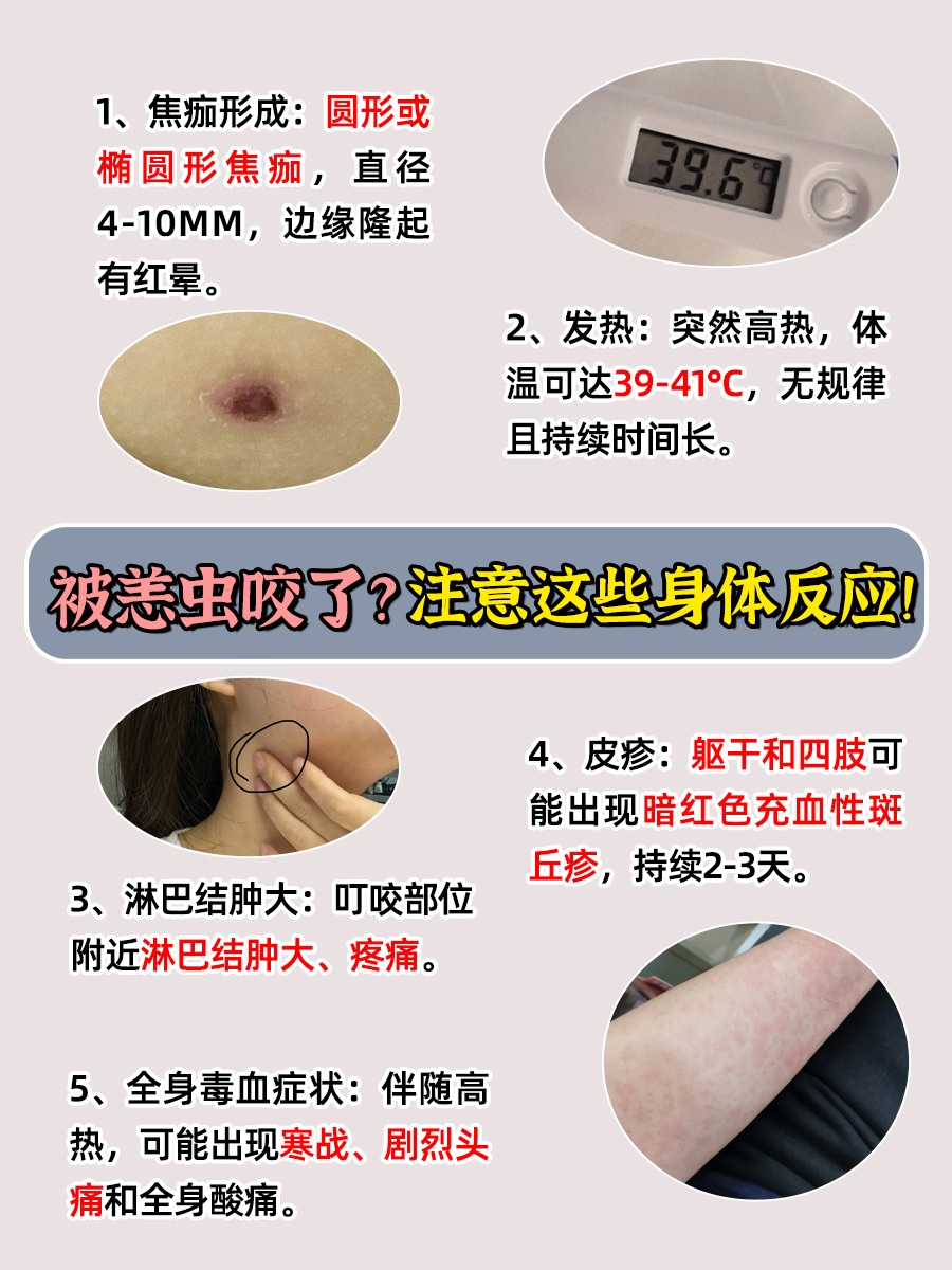 恙虫咬人后，这些症状要警惕！