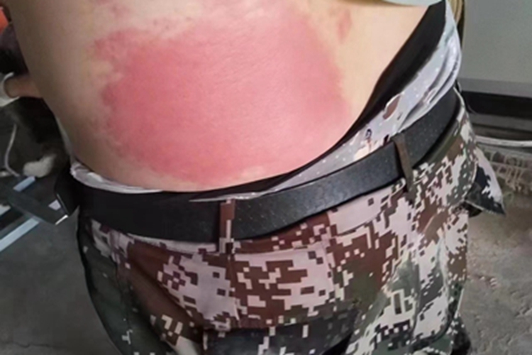 急性接触性皮炎腰部红斑图 急性接触性皮炎腰部红斑图