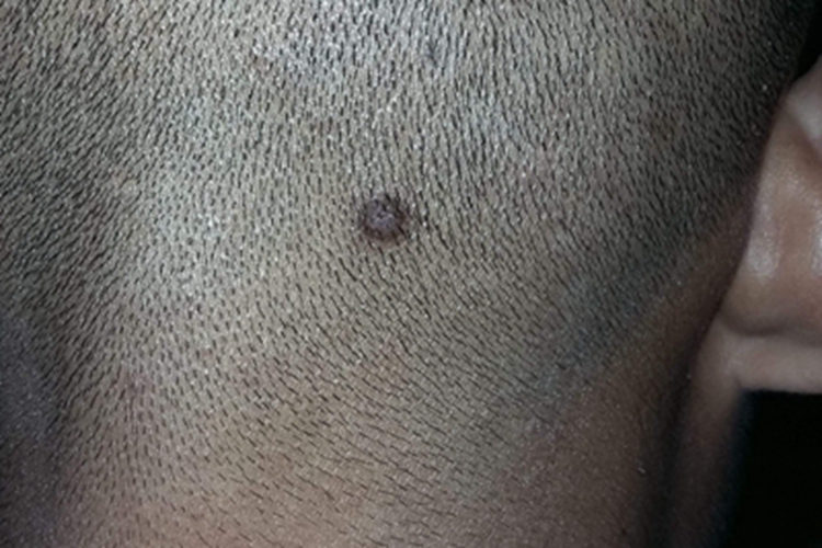 网状组织细胞肉芽肿头皮小疙瘩图 网状组织细胞肉芽肿头皮小疙瘩图