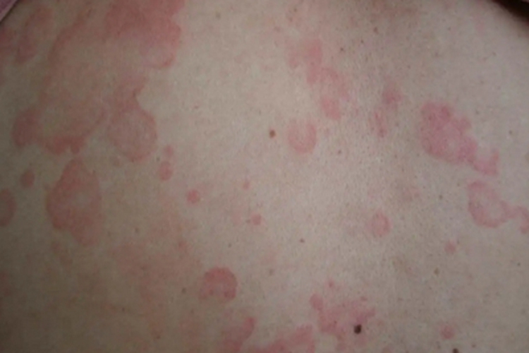 远心性环状红斑背部症状图