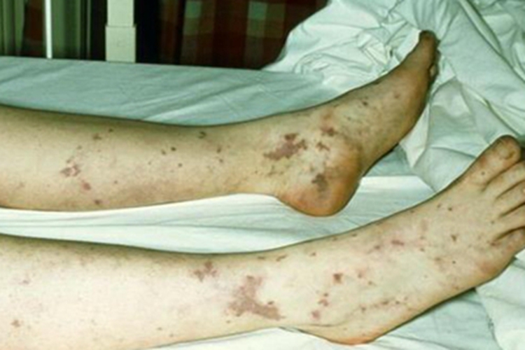 皮下出血小腿瘀斑图