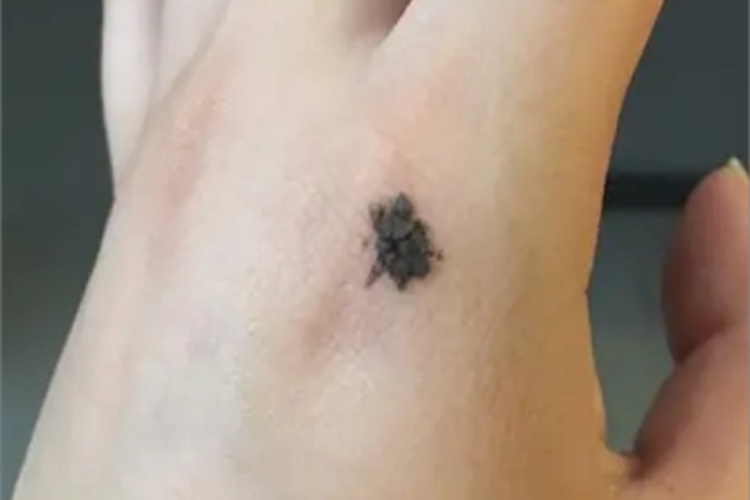 恶性雀斑样痣手背症状图