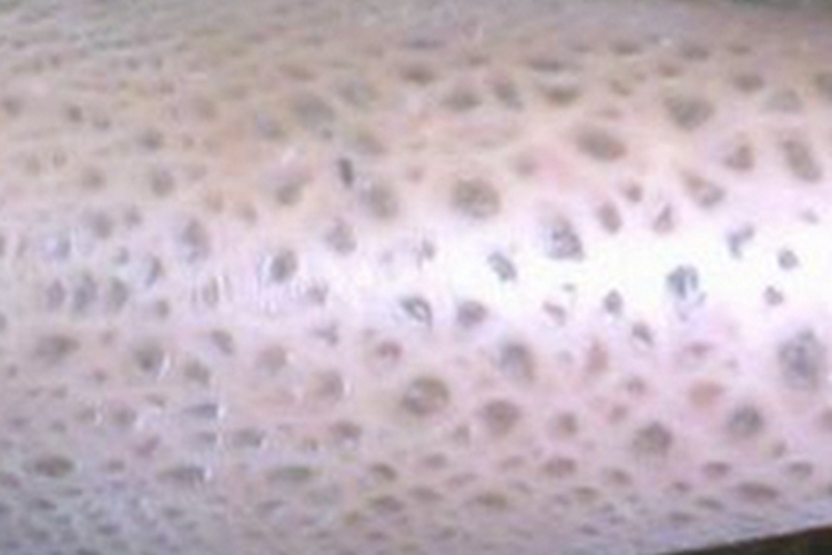 毛囊性鱼鳞病小腿症状图 毛囊性鱼鳞病小腿症状图