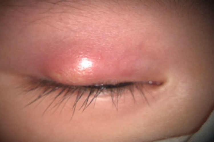 眼睑脓肿眼睑肿图