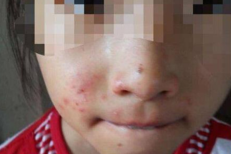 甲醛超标皮肤过敏图