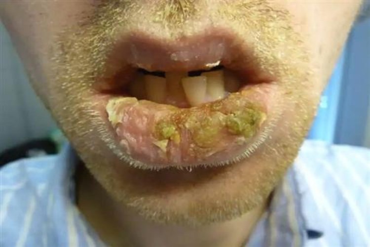 化脓性腺性唇炎嘴唇脱皮图 化脓性腺性唇炎嘴唇脱皮图