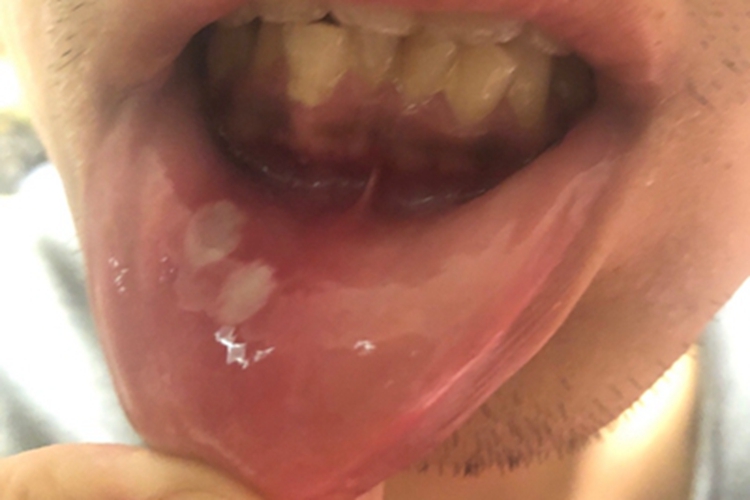 口腔溃疡唇内侧有白斑图