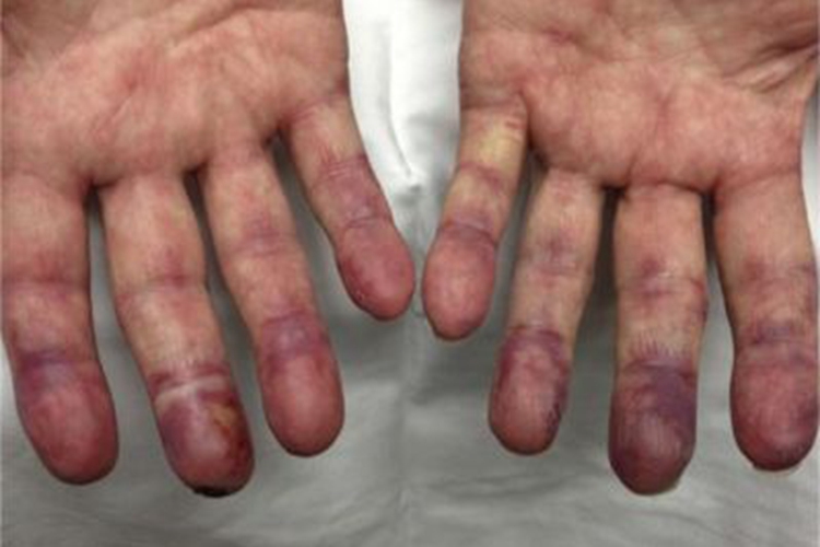 冷球蛋白血症皮肤发紫图