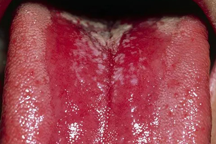 艾滋病鹅口疮图