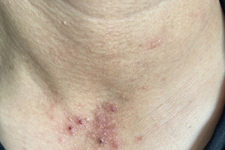 痒疹型多形性日光疹血痂图 痒疹型多形性日光疹血痂图