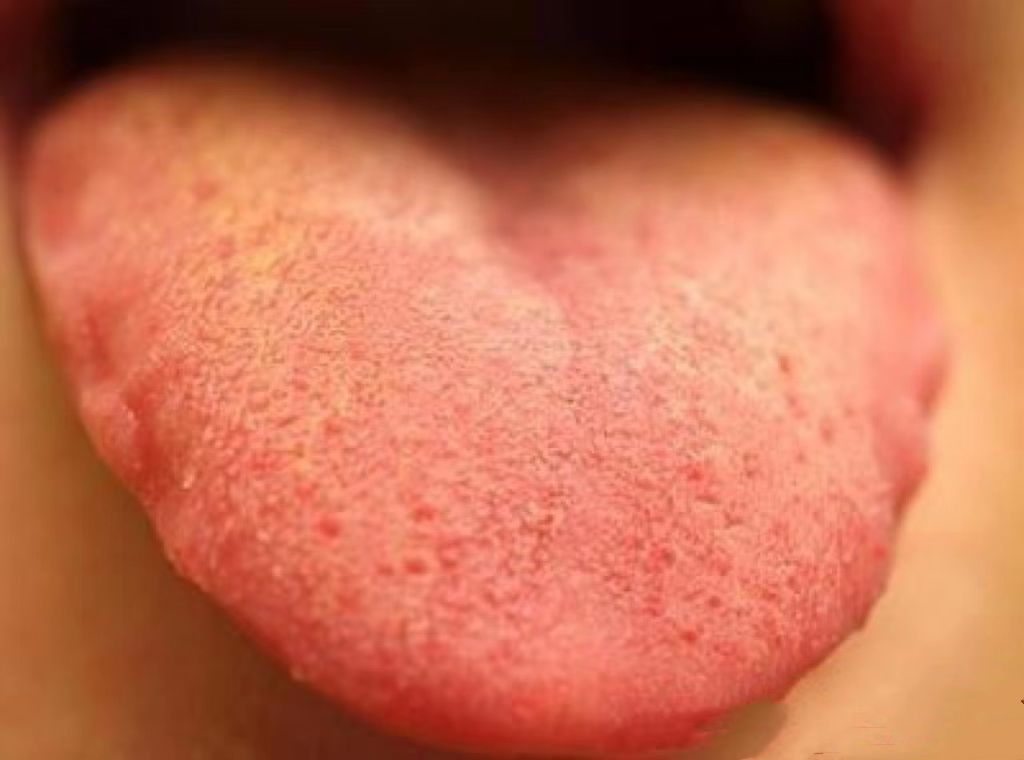 肝火旺舌苔发黄图