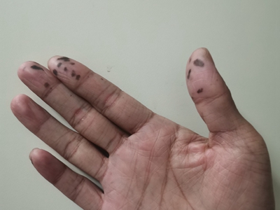 色素沉着息肉综合征的症状和图片 - 有来医生