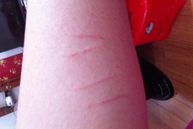 狂犬病二级暴露伤口图