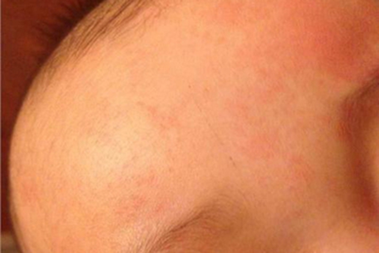 红痱额头有红斑红点图