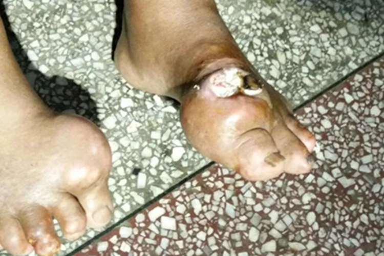 痛风脚背上硬包糜烂图