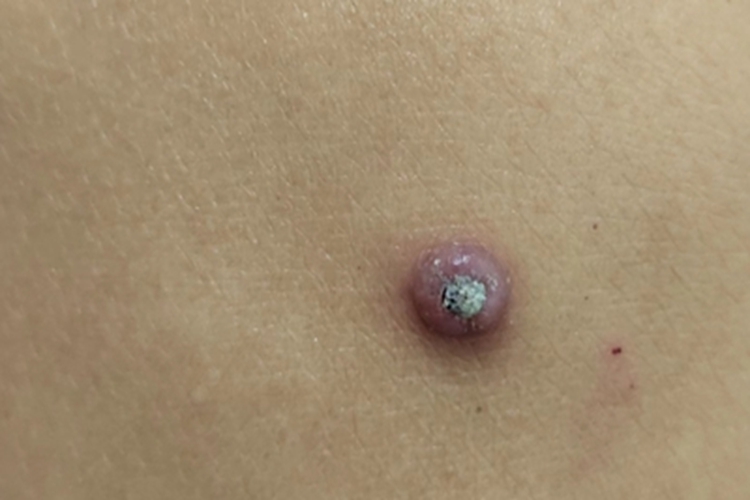 角化棘皮瘤大包图