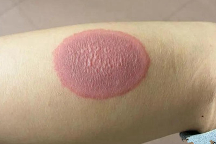 轻型多形红斑型药疹小腿症状图 轻型多形红斑型药疹小腿症状图