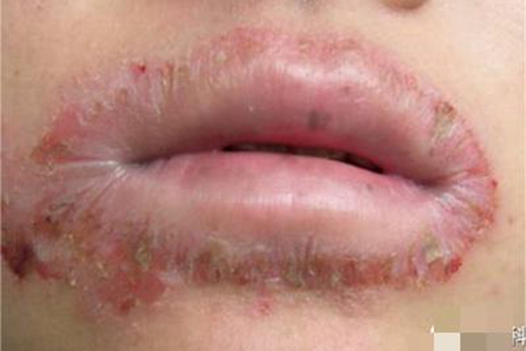 接触性唇炎口周症状图
