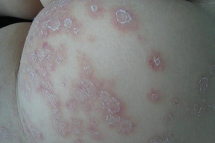 螨虫皮炎臀部红斑图