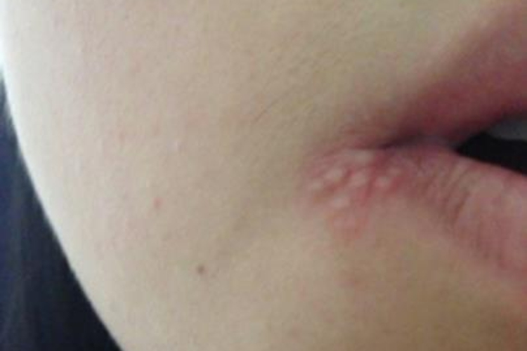 脸上单纯疱疹图