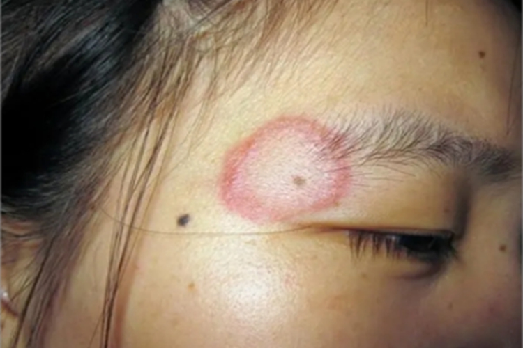 体癣眉毛红斑图