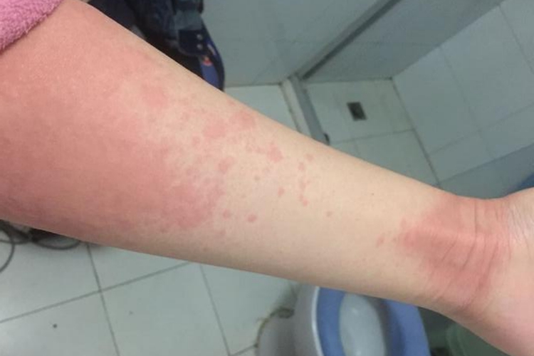 手臂过敏起红斑图