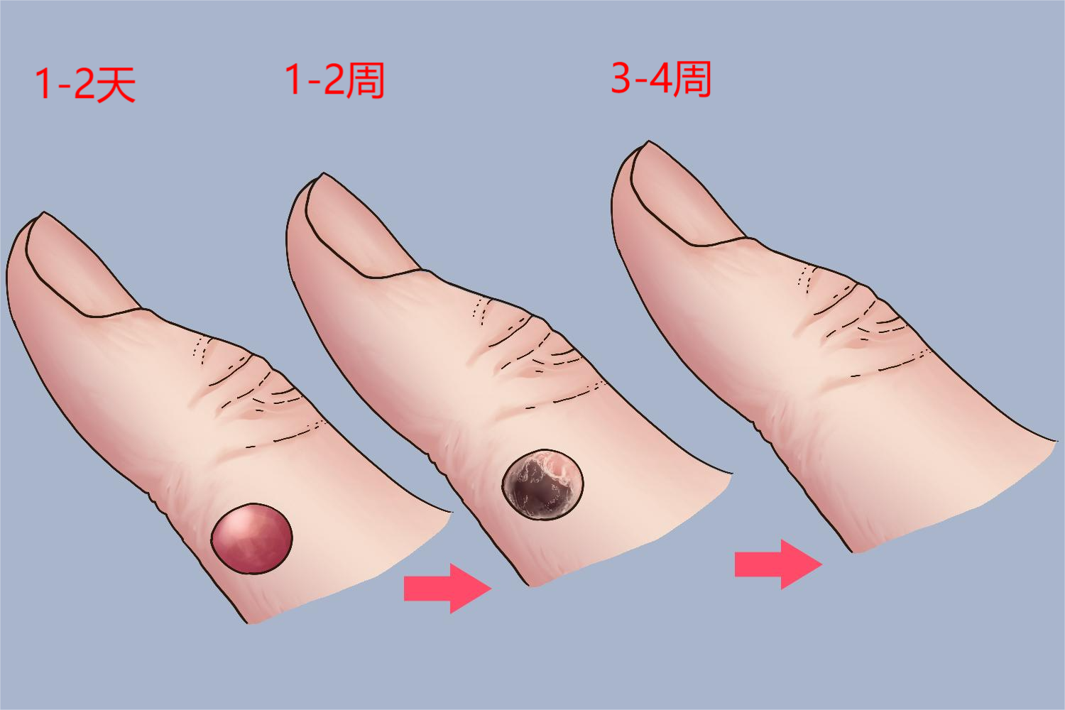 液氮冷冻去疣恢复过程图