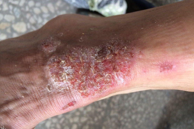 亚急性湿疹脚踝糜烂图 亚急性湿疹脚踝糜烂图