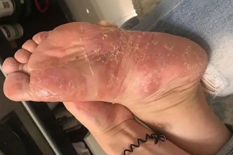 跖部脓疱鳞屑与褐黄色结痂图