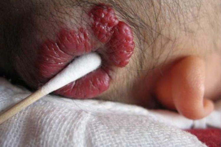 毛细血管瘤头部肿块图