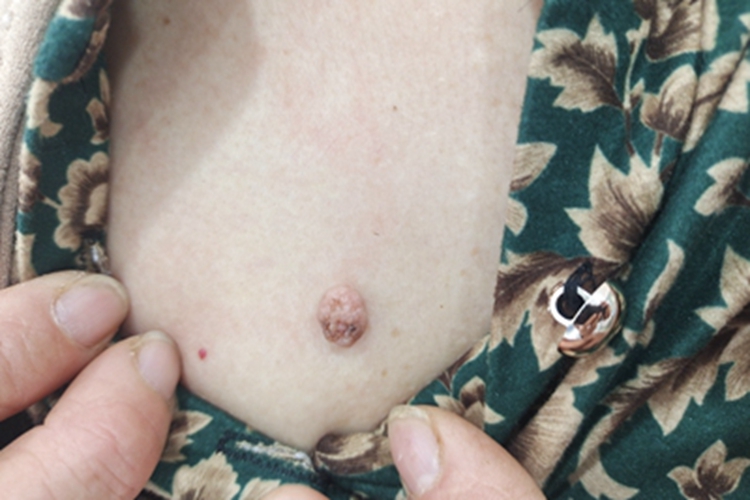 皮肤纤维瘤胸部疙瘩图