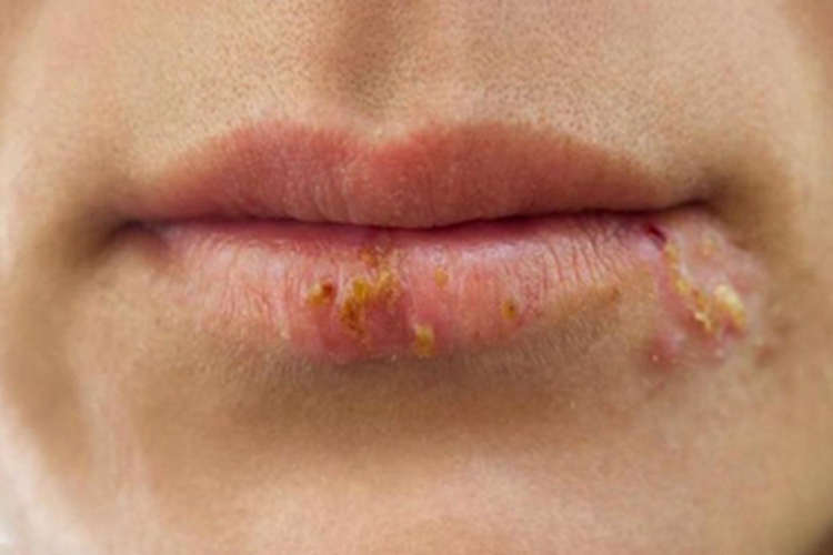 唇疱疹嘴唇结痂图