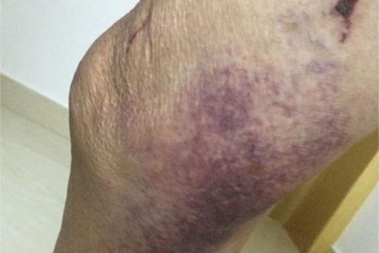 老年性皮肤萎缩腿紫斑图