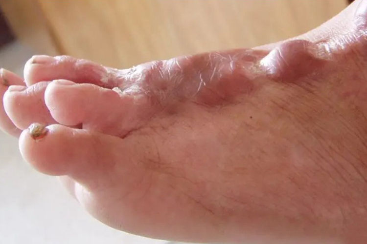 后天仰趾畸形图