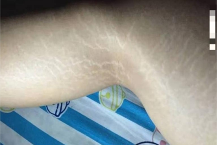 萎缩纹腿条纹图