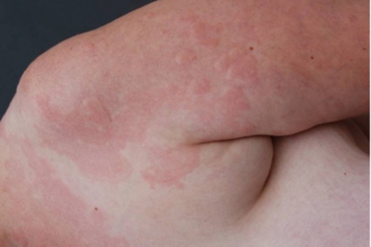 荨麻疹性血管炎风团图