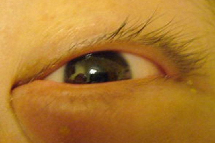 眼睑脓肿下眼睑肿胀图