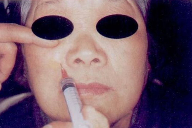 眶下神经口外进针点图 眶下神经口外进针点图