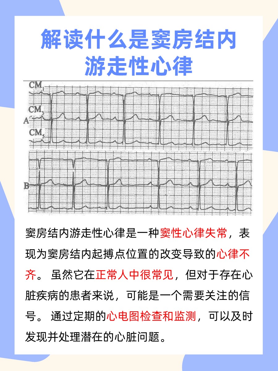 窦房结内游走性心律：解读心脏节律的微妙变化