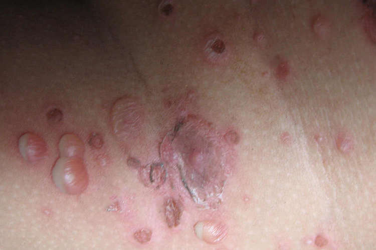 脓疱疮脓疱图 脓疱疮脓疱图
