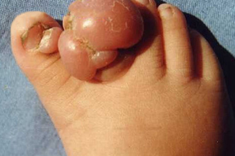 掌跖纤维瘤病症状图