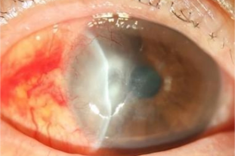 红眼病眼睛充血伴有一层膜图