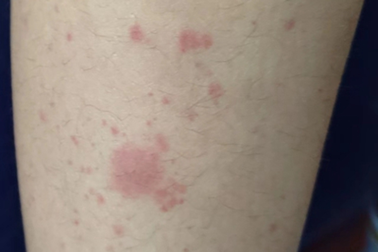 过敏性紫癜右小腿长红斑图