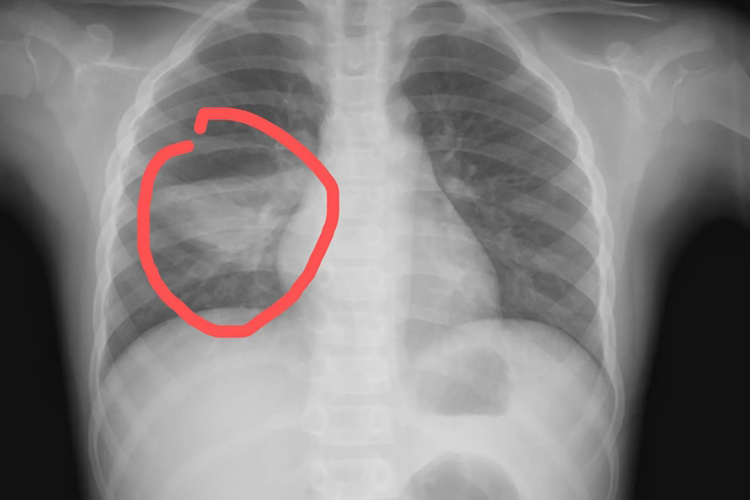 小儿肺炎胸片图 小儿肺炎胸片图