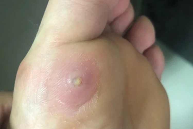 硬鸡眼脚底硬块图