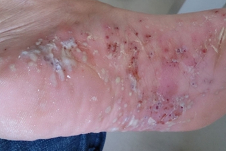 脓疱疮脚底脓包图 脓疱疮脚底脓包图